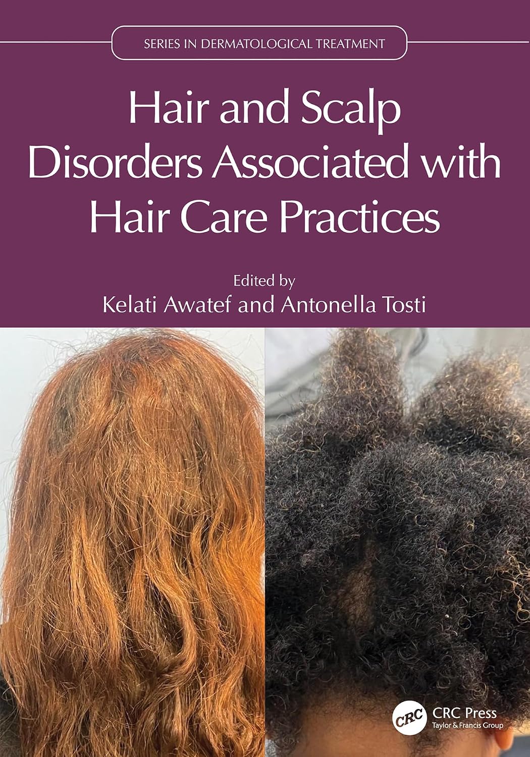 Couverture du livre Hair and Scalp Disorders Associated with Hair Care Practices — CRC Press
